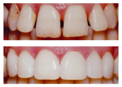 bonding-diastema-closure