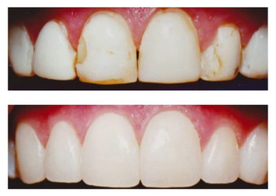 bonding-improving-old-composite-fillings