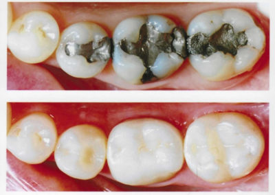 Replaced Silver Colored Fillings with Tooth Colored Fillings