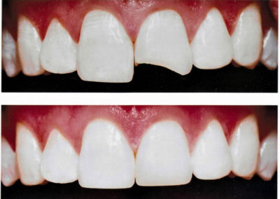 Bonded Repair of Broken Tooth